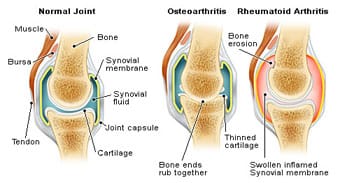 rheumatoid_arthritis